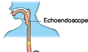 Illustration indicating the location of the Echoendoscope in the Oesophagus