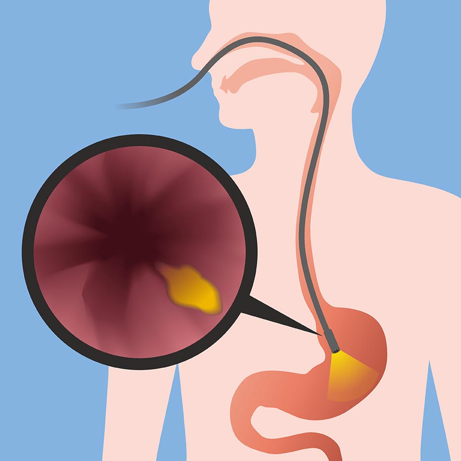 Endoscopy Procedure: An endoscope passes through the digestive tract, shining a light in the stomach