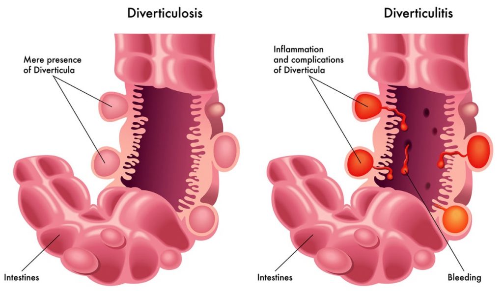 Image showing the differing between diverticulosis and diverticulitisculitis